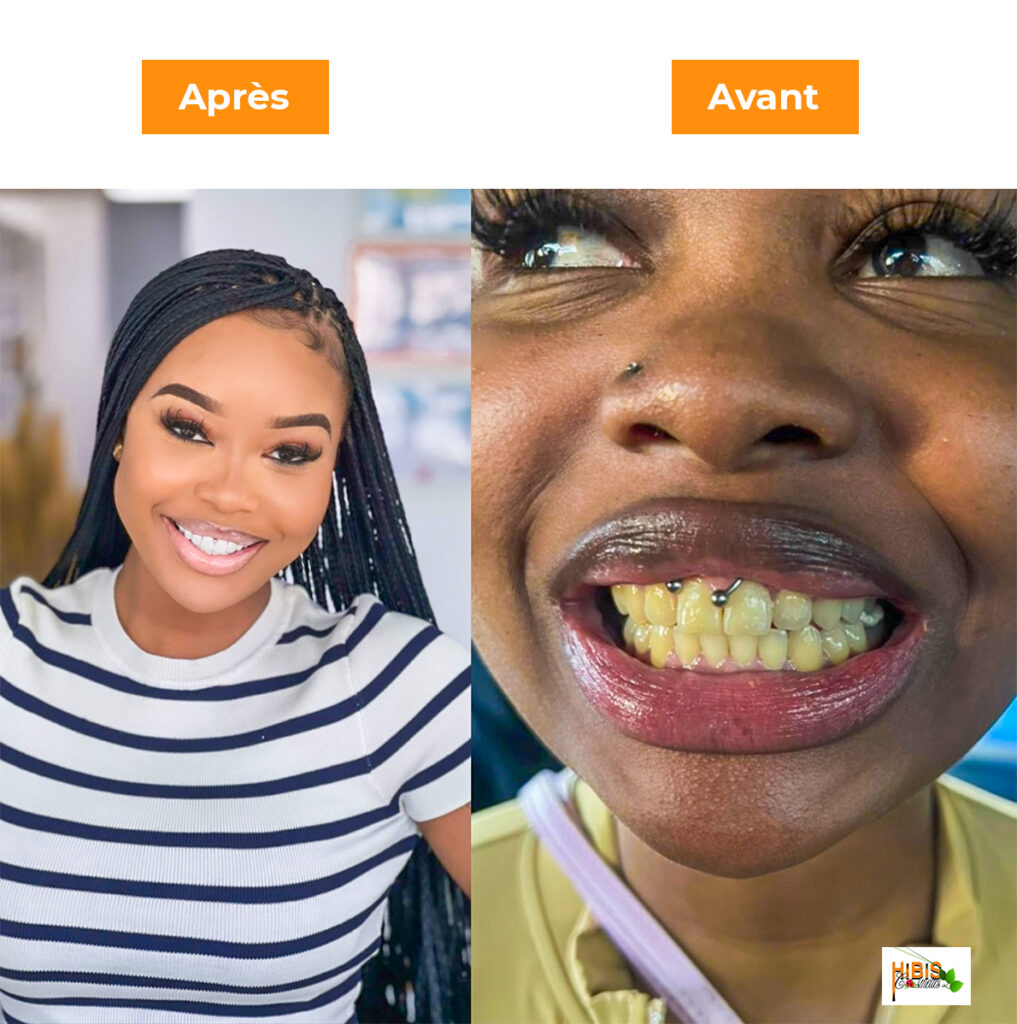 soin-de-blanchissement-dentaire soin-de-blanchissement-dentaire