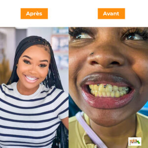 soin-de-blanchissement-dentaire