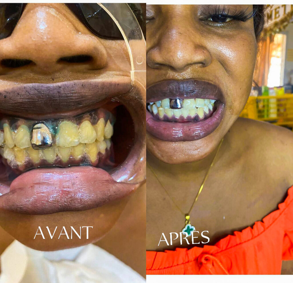 soi-de-blanchessement-dentaire