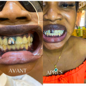 soi-de-blanchessement-dentaire